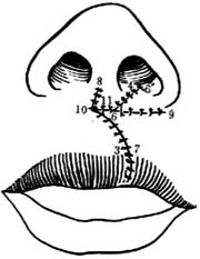单侧唇裂瓣修复术图片