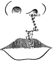 单侧唇裂瓣修复术图片