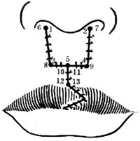 双侧唇裂的修复术图片