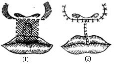 唇缺损手术图片