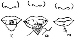 唇缺损手术图片