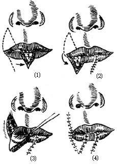 唇缺损手术图片