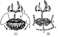 唇缺损手术图片
