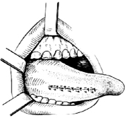 舌部分切除术图片