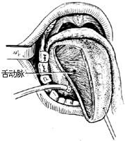 半舌切除术图片