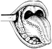 半舌切除术图片