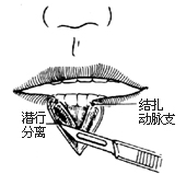 唇癌V形切除术图片