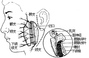 腮腺切除术图片