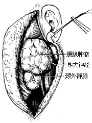 腮腺切除术图片