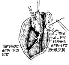 腮腺切除术图片