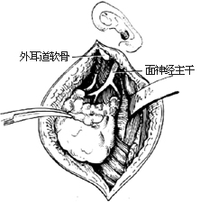 腮腺切除术图片