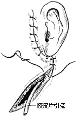 腮腺切除术图片