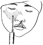 唇裂修复术图片