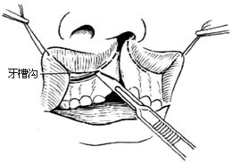 唇裂修复术图片