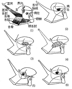 半舌（颌）颈联合清除术图片