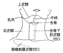 半舌（颌）颈联合清除术图片