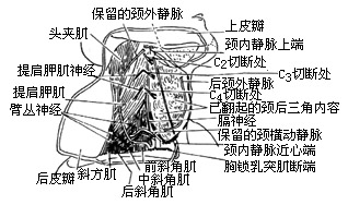 半舌（颌）颈联合清除术图片