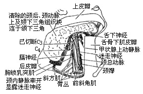 半舌（颌）颈联合清除术图片