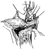 半舌（颌）颈联合清除术图片
