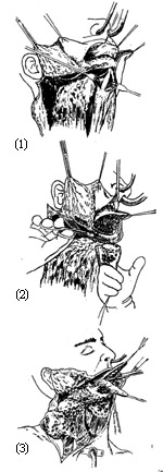 半舌（颌）颈联合清除术图片
