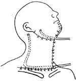 半舌（颌）颈联合清除术图片
