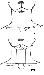 全舌（颌）颈联合清除术图片