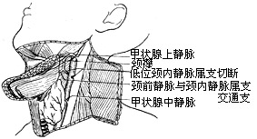 舌骨下肌皮瓣舌重建术图片