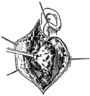 腮腺手术图片