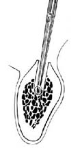 两段式螺旋型钛种植体植入术图片