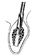 两段式螺旋型钛种植体植入术图片