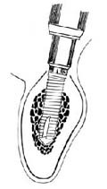 两段式螺旋型钛种植体植入术图片