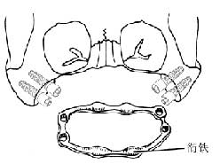 全上颌骨缺损种植义颌修复术图片