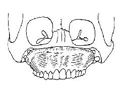 全上颌骨缺损种植义颌修复术图片