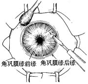 小梁切除术图片