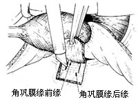 小梁切除术图片