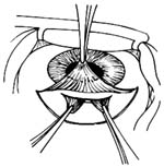 虹膜嵌顿术图片