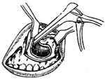 鼻显微手术图片