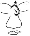 用邻近皮瓣整复鼻背、鼻尖、鼻梁缺损术图片