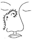 用邻近皮瓣整复鼻背、鼻尖、鼻梁缺损术图片