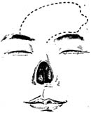 鼻成形术图片