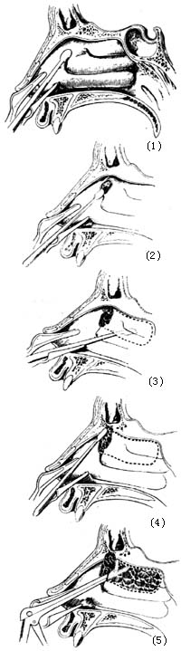 筛窦手术图片