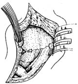 经蝶窦的脑垂体手术图片