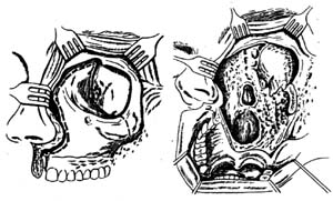 上颌骨截除及眶内容剜出术图片