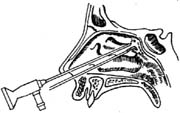 翼管神经手术图片