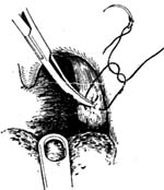 扁桃体挤切术图片