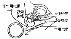 电子耳蜗植入术图片