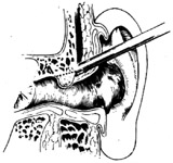 外耳道骨疣凿除术图片