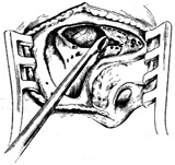 耳源性脑脓肿的外科疗法图片