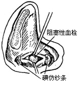 横窦周围脓肿和横窦栓塞的外科疗法图片