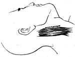 横窦周围脓肿和横窦栓塞的外科疗法图片